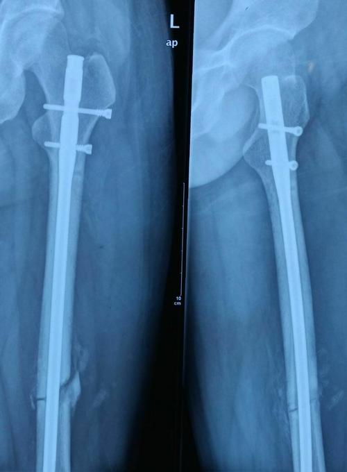 股骨干骨折闭合复位髓内固定