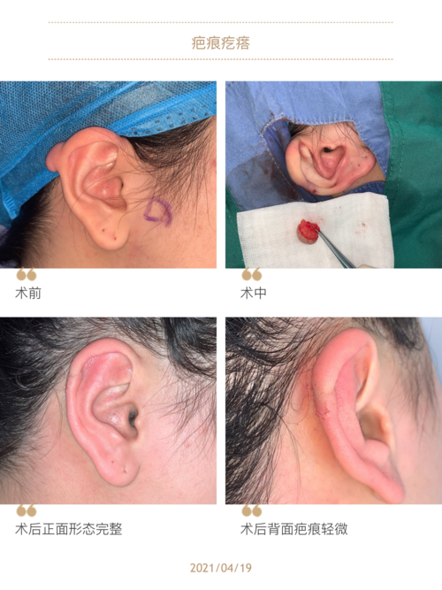 看了这张图你还敢打耳洞吗