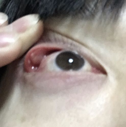 上眼皮里面长了个疙瘩,帮看看是什么鬼.