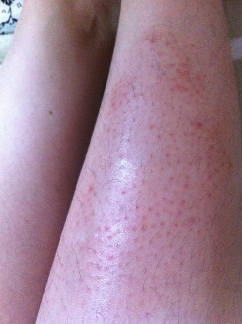 看看我的脚是不是毛囊炎,谢谢了!