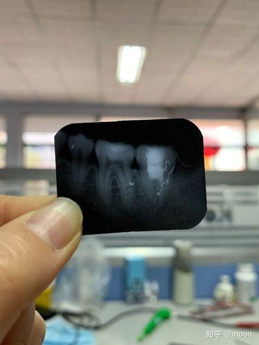 c型管根管治疗彻底了么