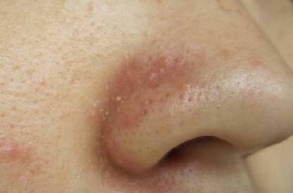 鼻子成这样了,到医院检查,显示无螨虫,那是不是就一定是脂溢性皮炎呢?