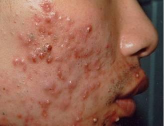 徐州哪家皮肤病医院治疗痤疮好