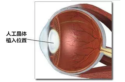 2,白内障手术的全名是:超声乳化 人工晶体植入术.