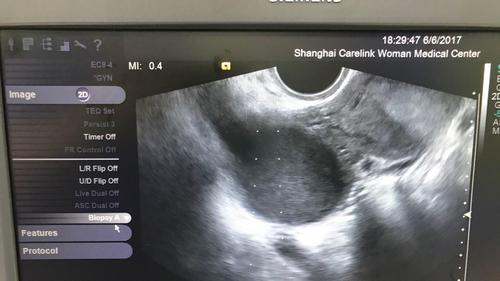 cyst of ovary)又名卵巢子宫内膜异位囊肿,是子宫内膜异位症的一种