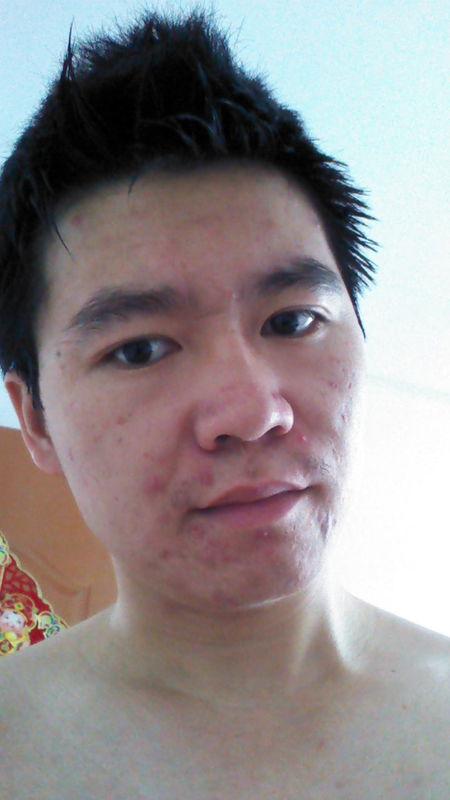 油性皮肤,脸上痘痘,痤疮,情况严重,需要