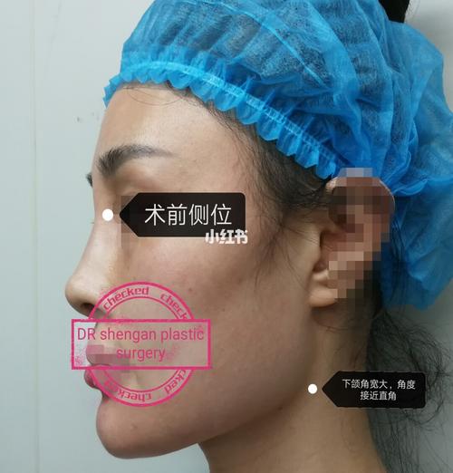 颧骨颧弓下颌角宽大_整形_医美_美妆_医美整形