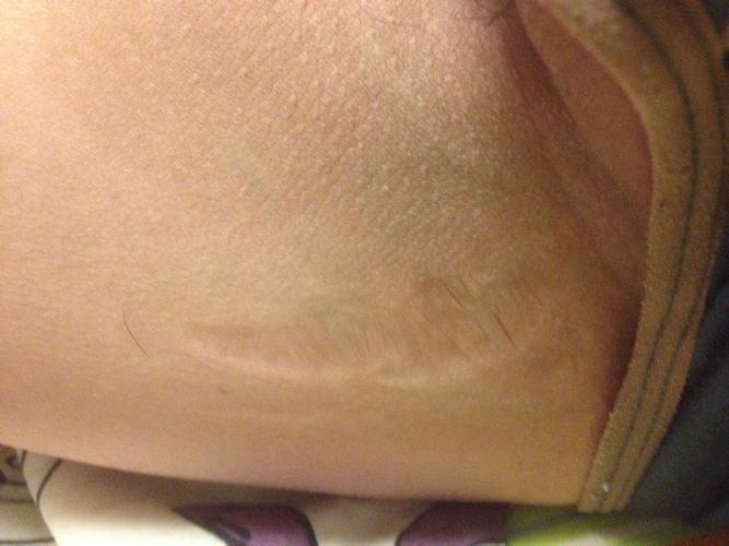 大腿内侧有一块皮肤 比周围皮肤薄 软黑.不疼不痒.6年