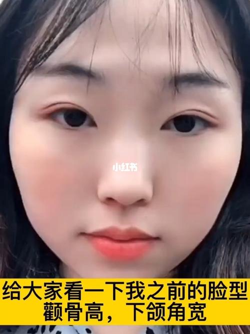 改脸型手术分享_脸型_颧骨_下颌角_颧骨下颌角_美妆