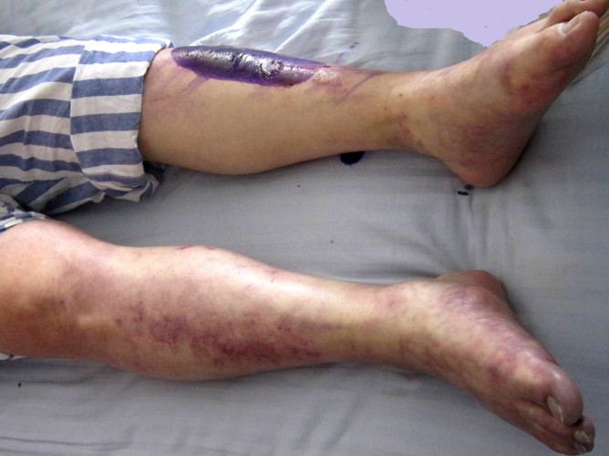 微创治疗下肢动脉硬化闭塞,避免截肢