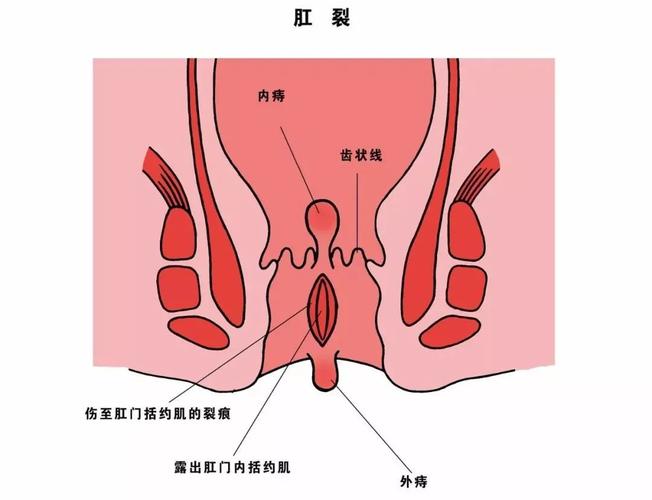 急性肛裂(肛裂也分型?