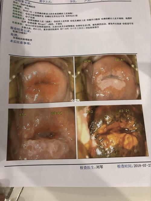 宫颈癌前病变治愈全过程_宫颈癌_hpv_疫苗_二胎_月经
