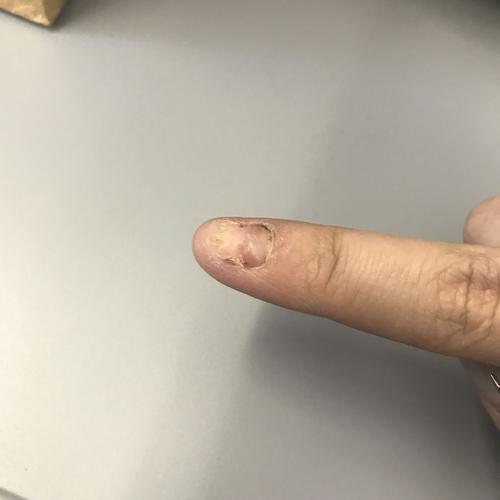 食指指甲拔掉了 现在重新生长 食指左边刚长出来的指甲和肉的地方很疼