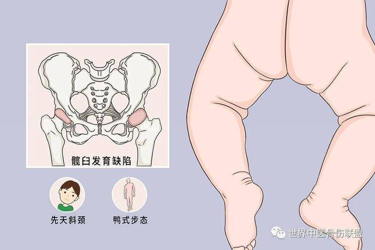 发育性髋关节发育不良
