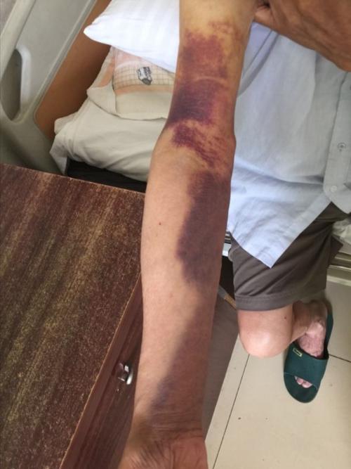 胳膊变紫色怎么回事