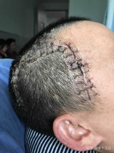 28岁脑出血做了开颅手术年轻人术后能恢复到什么程度