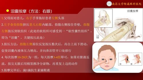 67关于"先天性鼻泪管阻塞,新生儿泪囊炎,泪囊按摩"的相关问题