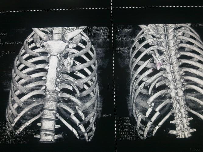 多发性肋骨骨折创伤性湿肺术后肺积血治疗讨论付经典肋骨重建图片