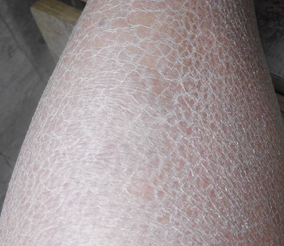 鱼鳞病可以吃什么食物