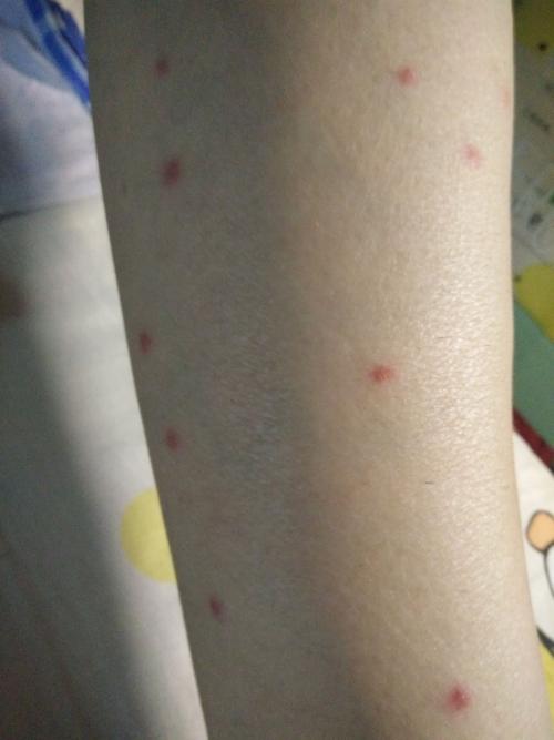 朋友腿上突然起了红点,这是怎么回事,拜托