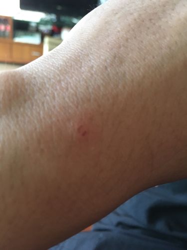 这个像是被狗咬的吗