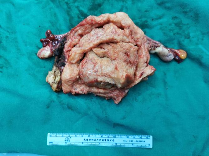 症合并腺肌瘤切除一例 写美篇 6月24日,腹腔镜下大子宫腺肌症切除一例