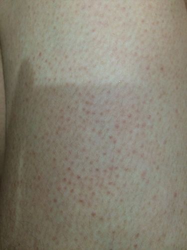   分享到:  2015-03-21 00:46 网友采纳 这是典型的毛周角化症