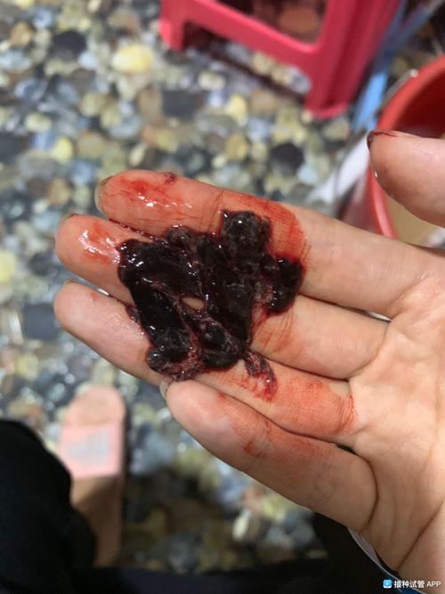 [试管婴儿]……这是血块还是我的胚胎?流出