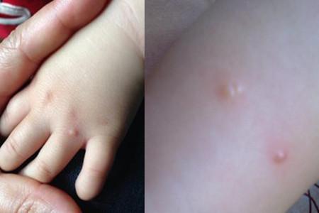 【图】了解水痘初期症状有哪些 做到早发现快治疗