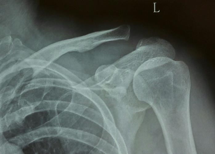 左肩锁关节脱位endbutton固定