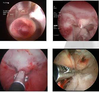 子宫内膜息肉剪除