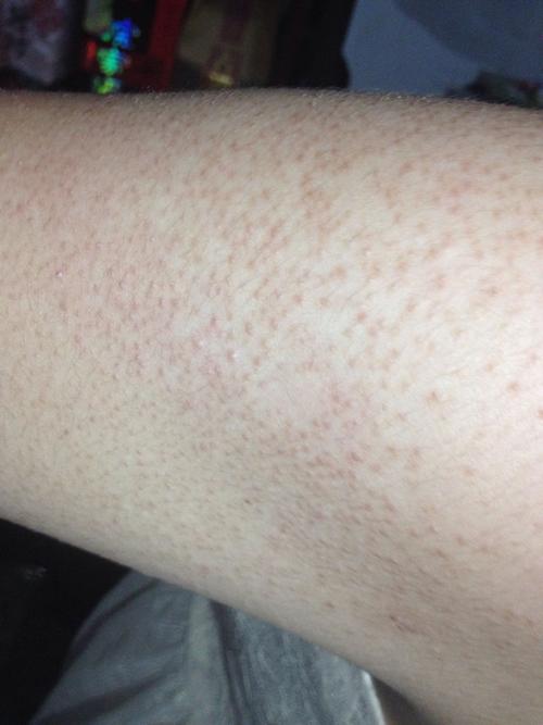 问:皮肤过敏问题,夏天一到,胳膊上就会起类似粉刺一样