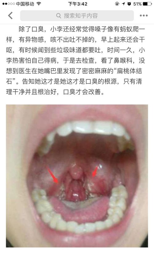 扁桃体结石是如何形成的?