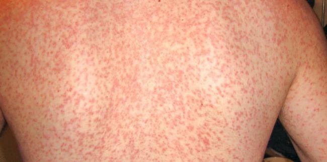 抗生素过敏?这种皮疹不简单!