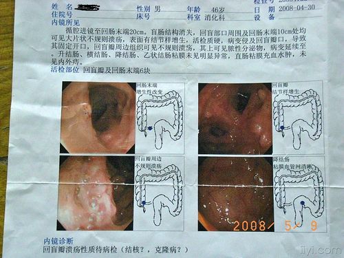 腹部包块病例大家讨论---腹部隐痛不适一月