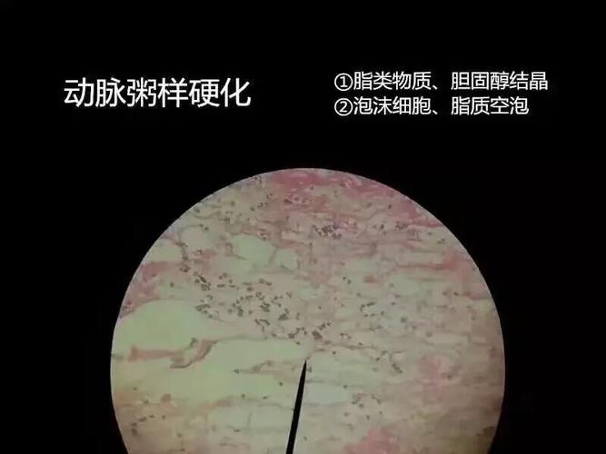 导致了心脏血液供应效果变差,引发了一系列症状,称为冠状动脉粥样硬化