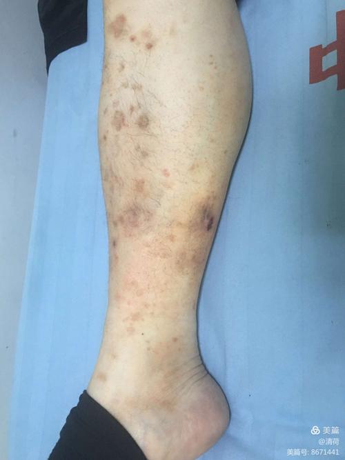 一例糖尿病皮肤病变病例观察