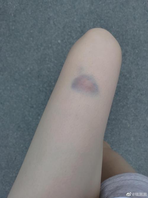 记录了一块淤青,我满闲的.