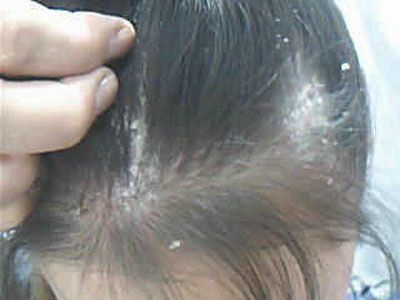 皮肤藓图片_皮肤癣_北京京城皮肤病医院(北京医保定点