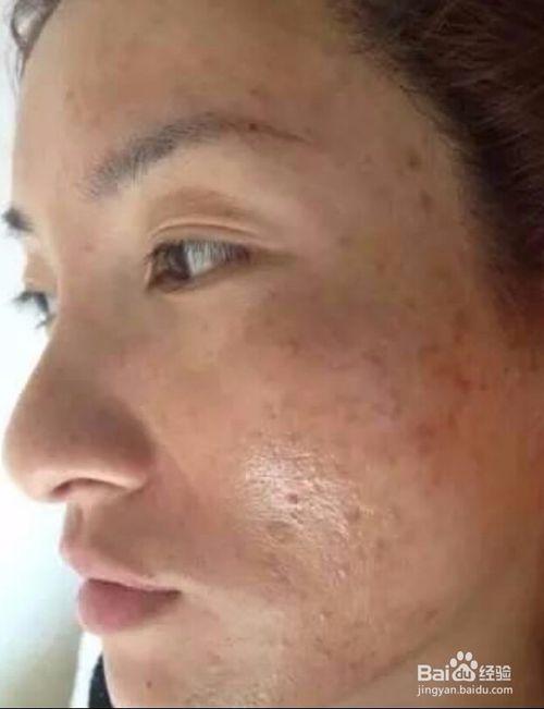 阿克苏地区乌什县脸上长斑是什么原因阿克苏地区乌什县脸上长色斑怎么