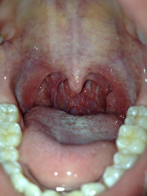 正常人的扁桃体图片