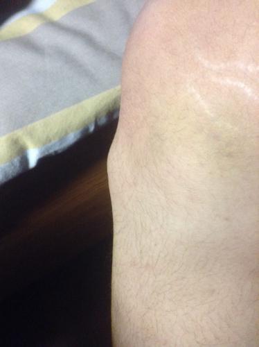 膝盖下左侧骨头比右侧突出 膝盖下的骨头折了怎么接呀,病人还不入麻