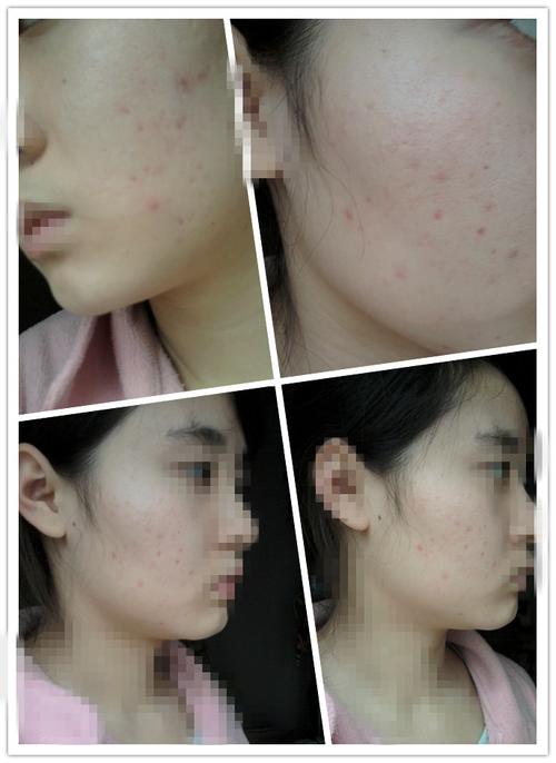 是铅中毒吗?还是皮肤的皮太薄了