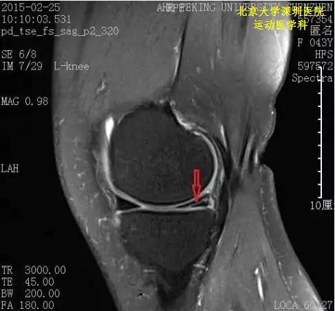 半月板急性损伤的dr回顾分析  mri是什么检查答:mri也就是磁共振成像