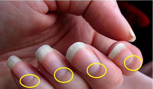 指甲出现3个"异常",暗示肾衰竭,千万别拖到"尿毒症"晚期