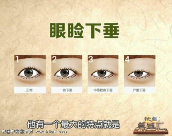 重症肌无力的表现