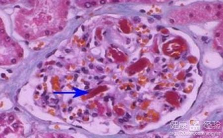 微血栓形成的表现微血栓形成怎么诊断