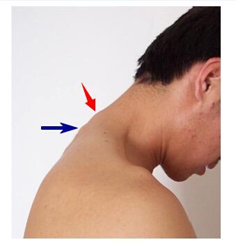 请问第七颈椎棘突具体是哪个位置?