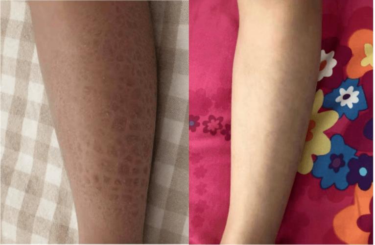 和鸡皮肤一样,鱼鳞病也是慢性遗传性疾病,经过合理有规律的治疗是可以