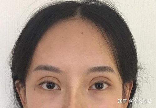 再比如像这位小姐姐,肉条感是真的明显,就算是网红大双眼皮,也看着很